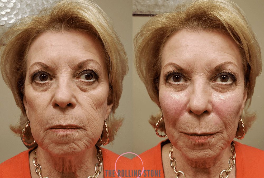 The Cheek Lift