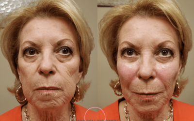 The Cheek Lift