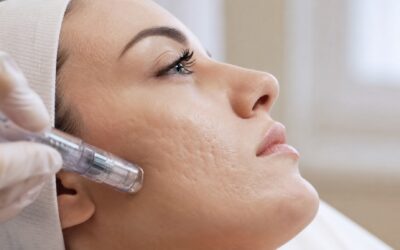 Best HydraFacial for Acne Scars: What to Expect
